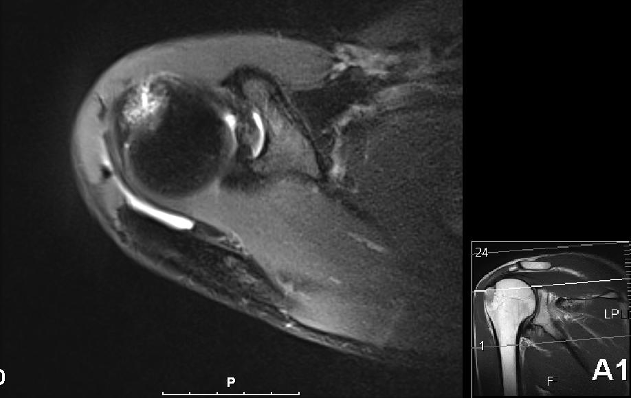 Allan - Skulder ovenfra 2