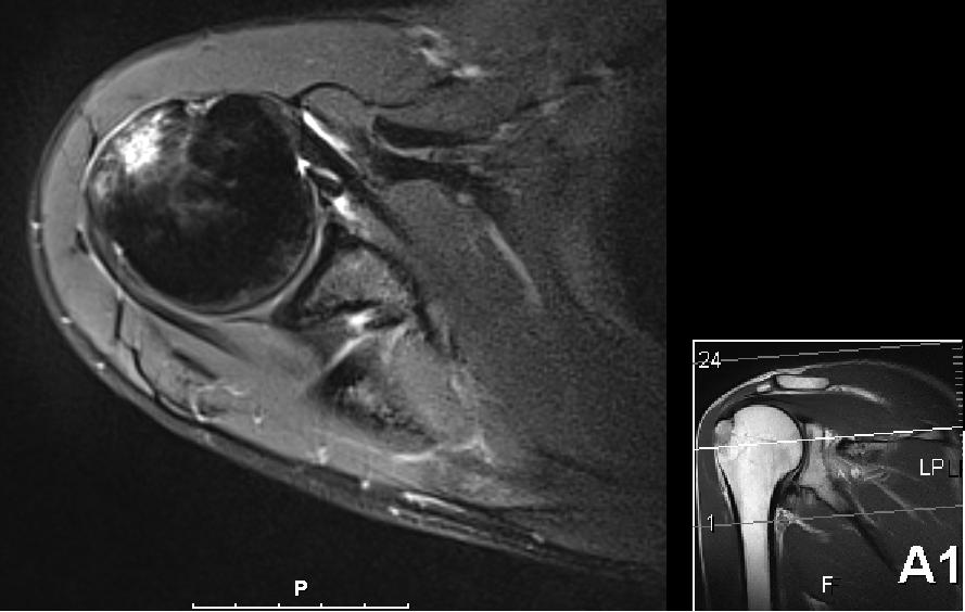 Allan - Skulder ovenfra 3