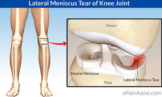 Triallan - Meniscus lateral 2