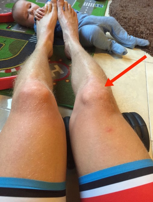 Triallan - Meniscus lateral