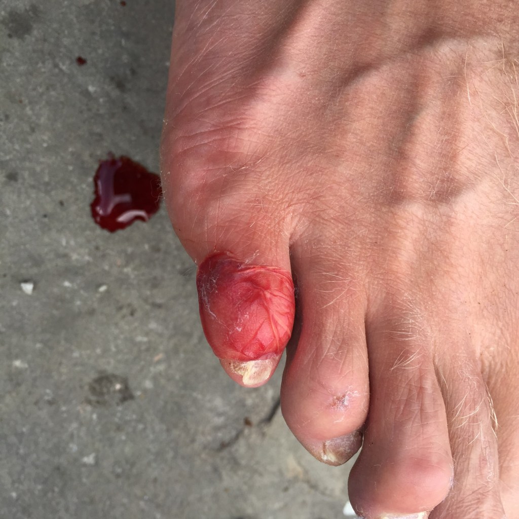 Allan Hovda - Norseman - blodig tå